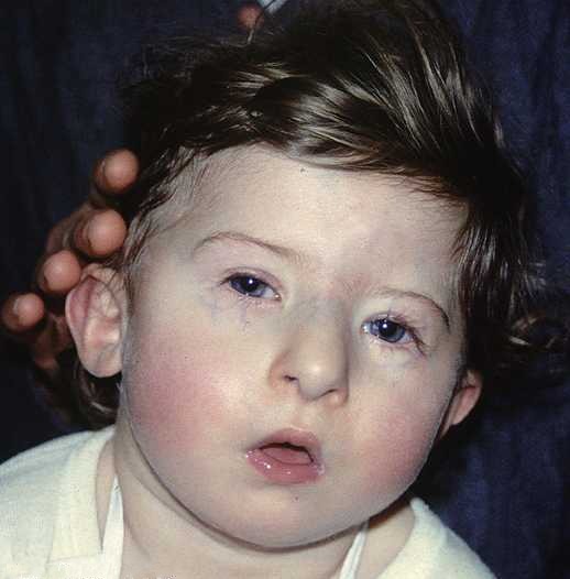 DiGeorge_syndrome1
