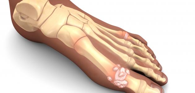 أهم_أمراض_الجهاز_الهيكلي